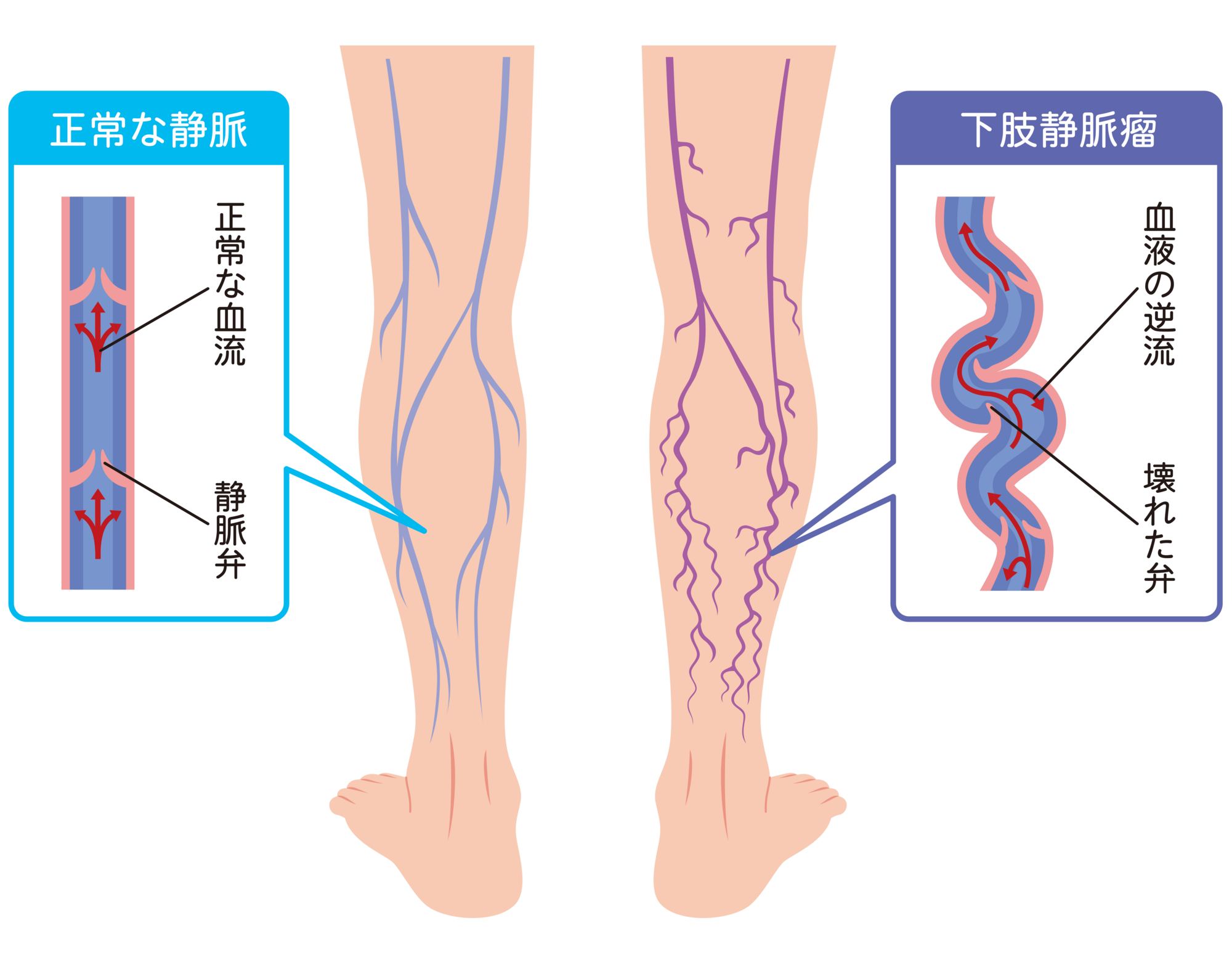 下肢静脈瘤の原因