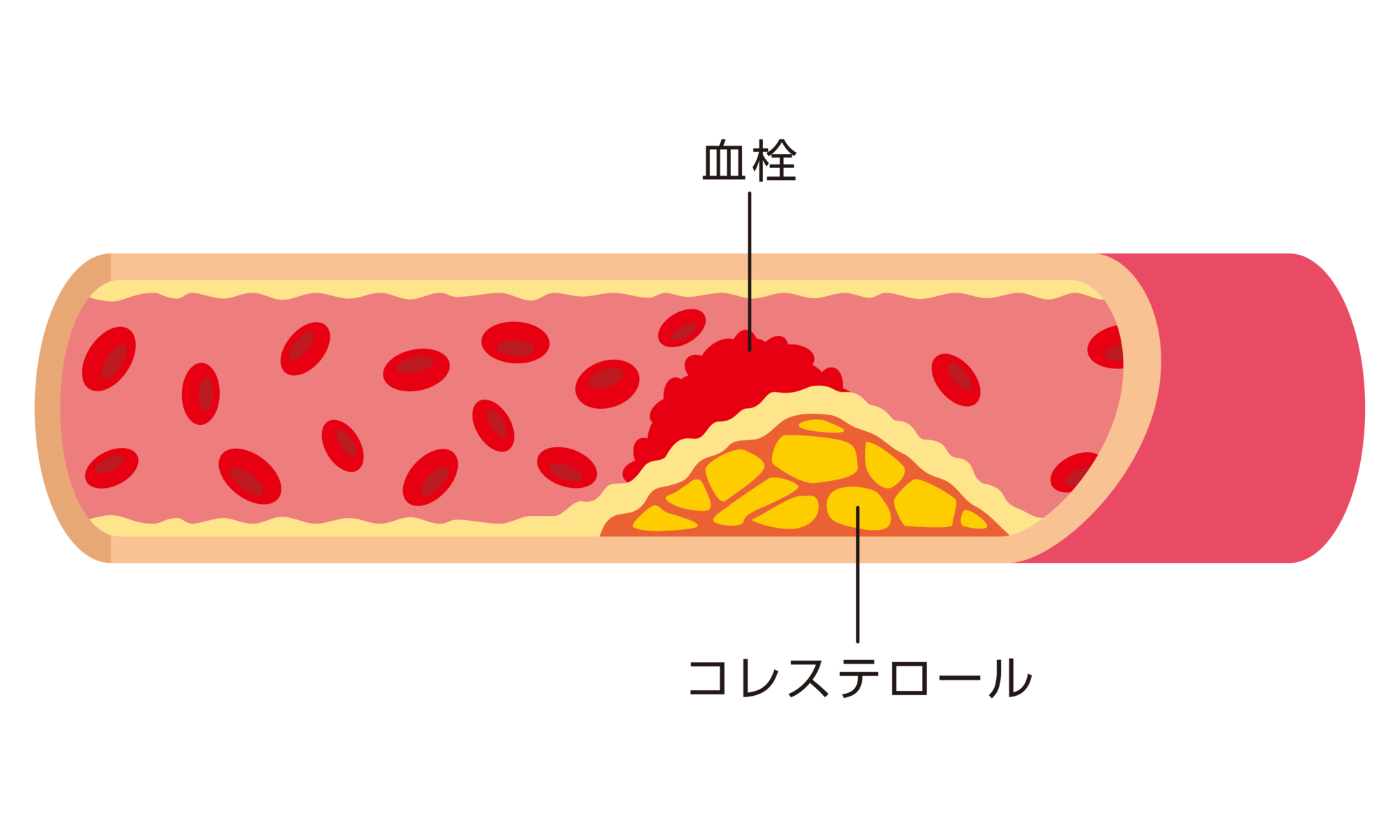 動脈硬化の原因