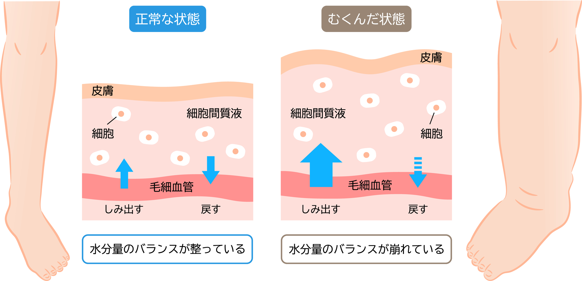 むくみとは