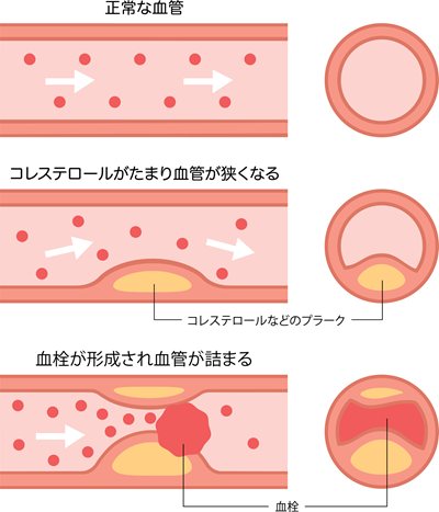 狭心症の原因